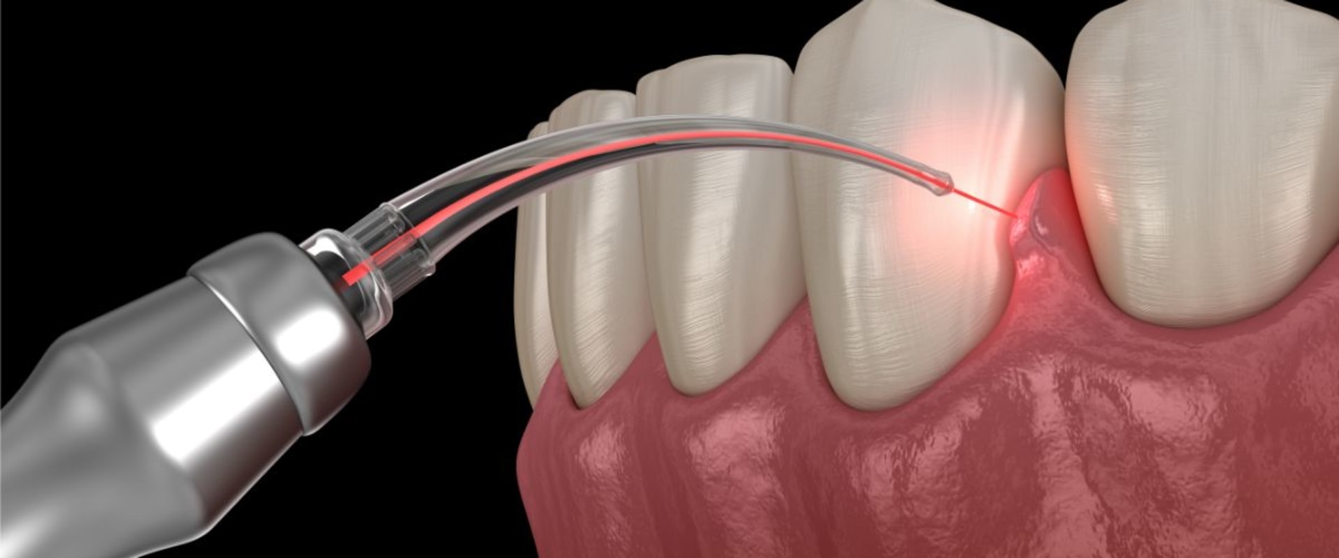 Enhancing Gum Health With Laser Dentistry: A Look At Cosmetic Periodontal Solutions In Rockville