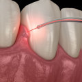 Enhancing Gum Health With Laser Dentistry: A Look At Cosmetic Periodontal Solutions In Rockville