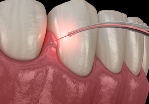 Enhancing Gum Health With Laser Dentistry: A Look At Cosmetic Periodontal Solutions In Rockville